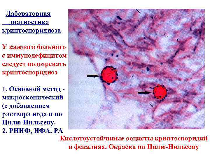  Лабораторная диагностика криптоспоридиоза У каждого больного с иммунодефицитом следует подозревать криптоспоридиоз 1. Основной