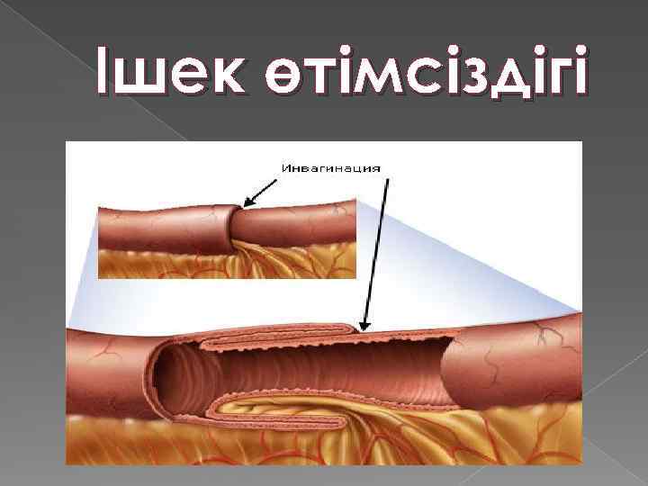 Ішек өтімсіздігі 