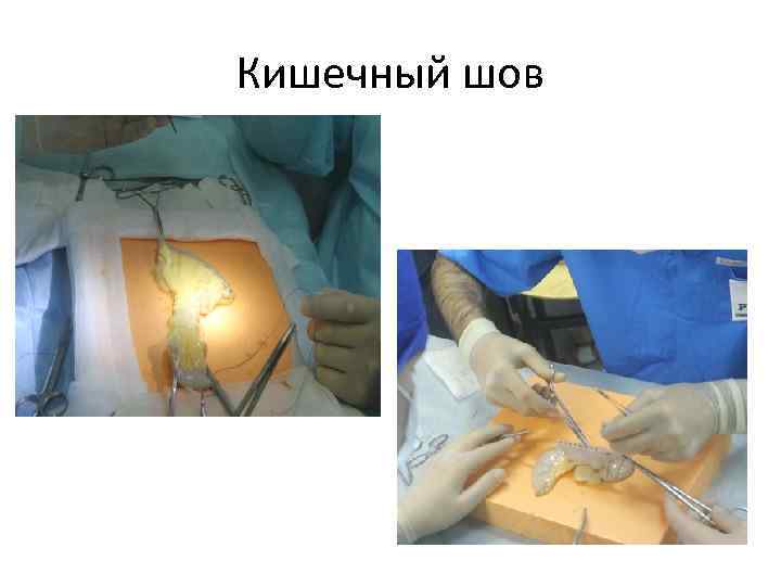 Кишечный шов 