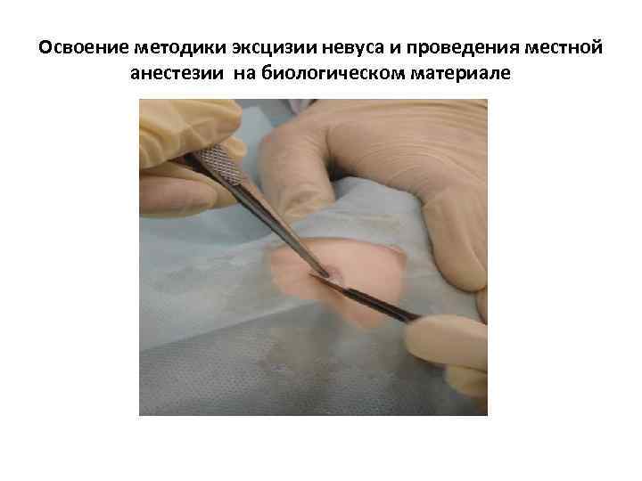 Освоение методики эксцизии невуса и проведения местной анестезии на биологическом материале 