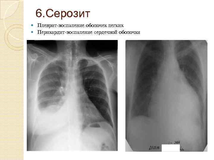 6. Серозит Плеврит-воспаление оболочек легких Перикардит-воспаление сердечной оболочки 