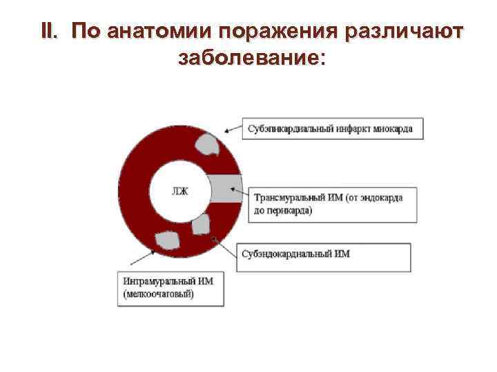 II. По анатомии поражения различают заболевание: 