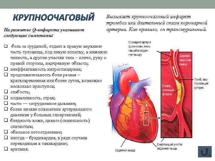 На развитие Q-инфаркта указывают следующие симптомы: Вызывает крупноочаговый инфаркт тромбоз или длительный спазм коронарной