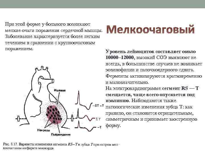 При этой форме у больного возникают мелкие очаги поражения сердечной мышцы. Заболевание характеризуется более