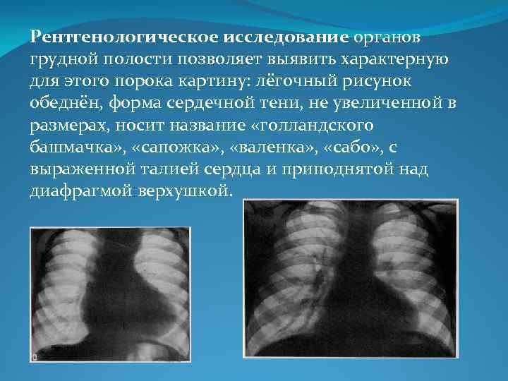 Ячеистая деформация легочного рисунка характерна для