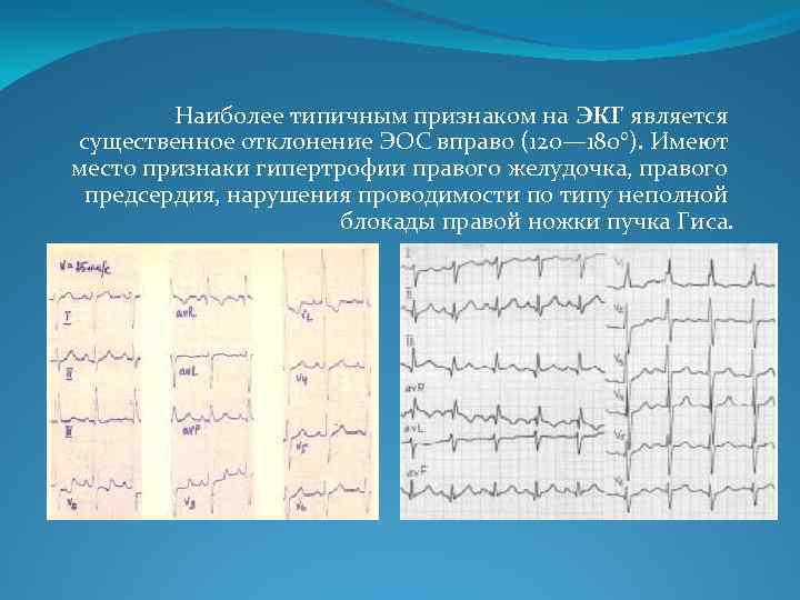 Наиболее типичным признаком на ЭКГ является существенное отклонение ЭОС вправо (120— 180°). Имеют место