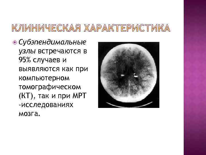  Субэпендимальные узлы встречаются в 95% случаев и выявляются как при компьютерном томографическом (КТ),