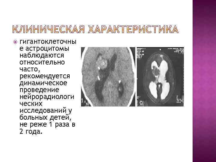  гигантоклеточны е астроцитомы наблюдаются относительно часто, рекомендуется динамическое проведение нейрорадиологи ческих исследований у