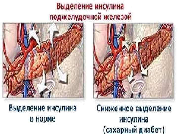 Екінші типті диабеттің емі 1) Гипокаллориялы диетотерапия; 2) Физикалық жүктемені күшейту; 3) Қант мөлшерін