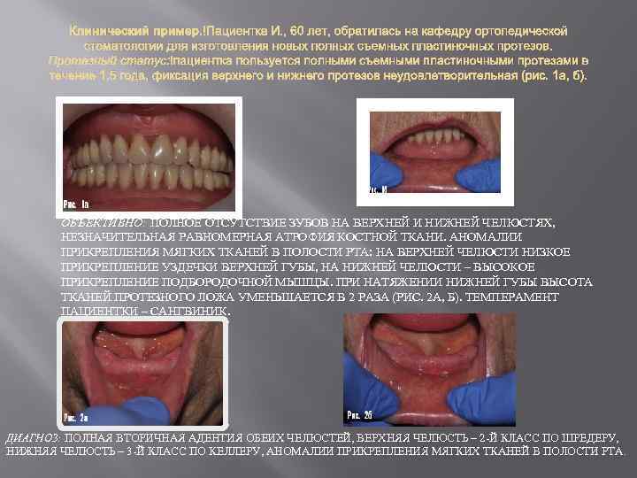 Клинический пример. Пациентка И. , 60 лет, обратилась на кафедру ортопедической стоматологии для изготовления