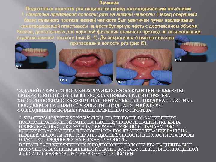 Лечение Подготовка полости рта пациентки перед ортопедическим лечением. 1. Пластика преддверия полости рта на