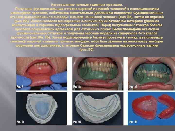 Изготовление полных съемных протезов. Получены функциональные оттиски верхней и нижней челюстей с использованием имеющихся