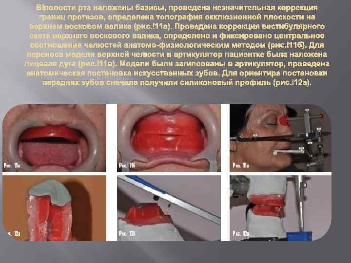 В полости рта наложены базисы, проведена незначительная коррекция границ протезов, определена топография окклюзионной плоскости