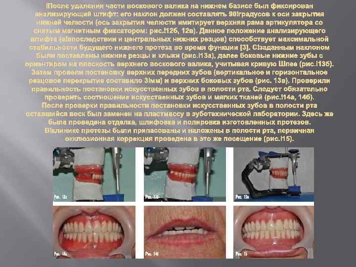  После удаления части воскового валика на нижнем базисе был фиксирован анализирующий штифт: его