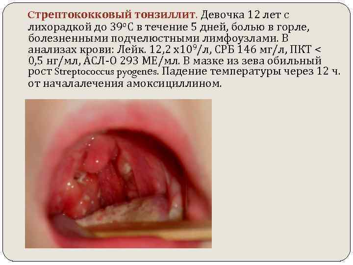  Cтрептококковый тонзиллит. Девочка 12 лет с лихорадкой до 39 о. С в течение