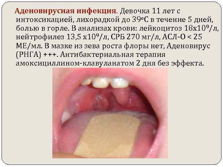  Аденовирусная инфекция. Девочка 11 лет с интоксикацией, лихорадкой до 39 о. С в