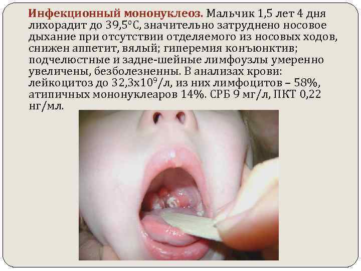  Инфекционный мононуклеоз. Мальчик 1, 5 лет 4 дня лихорадит до 39, 5 о.