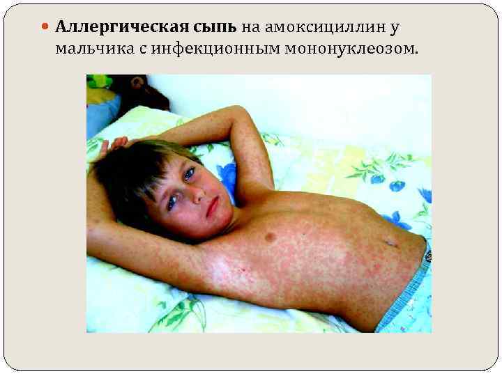  Аллергическая сыпь на амоксициллин у мальчика с инфекционным мононуклеозом. 