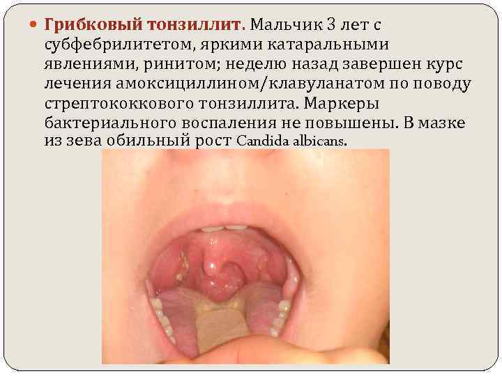  Грибковый тонзиллит. Мальчик 3 лет с субфебрилитетом, яркими катаральными явлениями, ринитом; неделю назад
