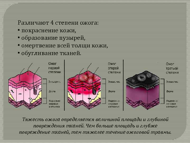 Различают 4 степени ожога: • покраснение кожи, • образование пузырей, • омертвение всей толщи