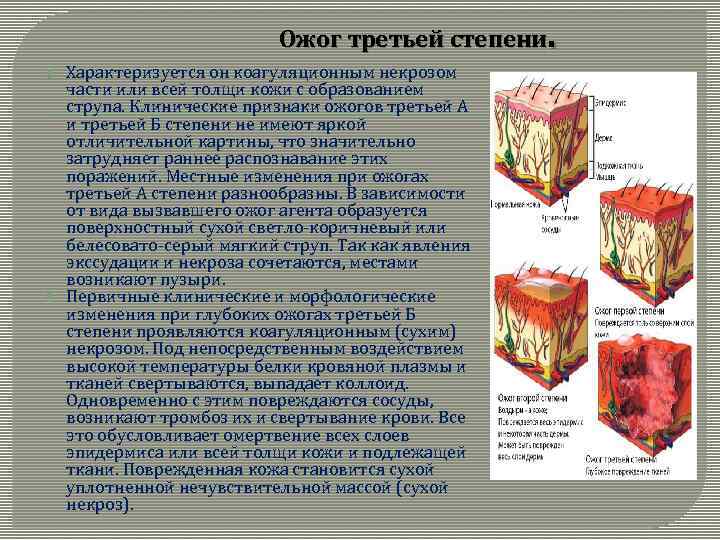 . Ожог третьей степени Характеризуется он коагуляционным некрозом части или всей толщи кожи с