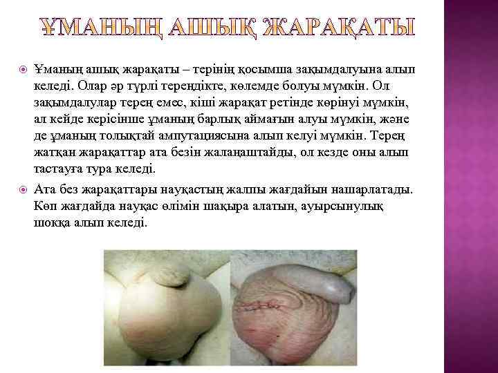  Ұманың ашық жарақаты – терінің қосымша зақымдалуына алып келеді. Олар әр түрлі тереңдікте,