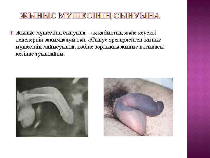  Жыныс мүшесінің сынуына – ақ қабықтың және кеуекті денелердің зақымдалуы тән. «Сыну» эрегирленген