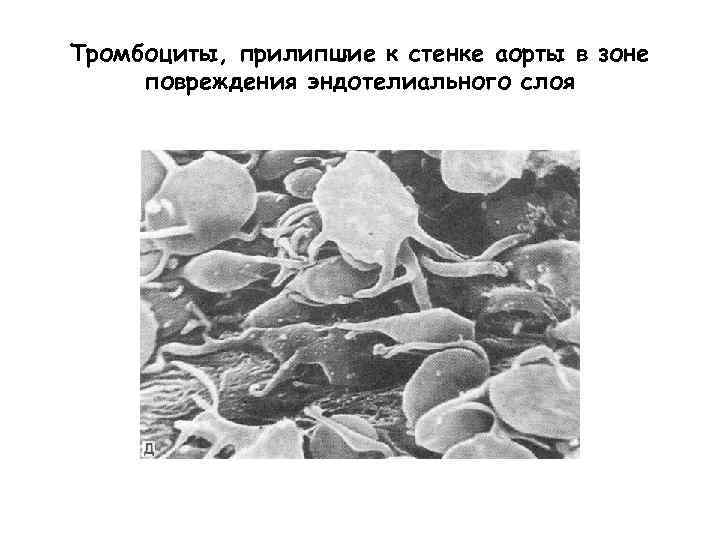 Тромбоциты, прилипшие к стенке аорты в зоне повреждения эндотелиального слоя 