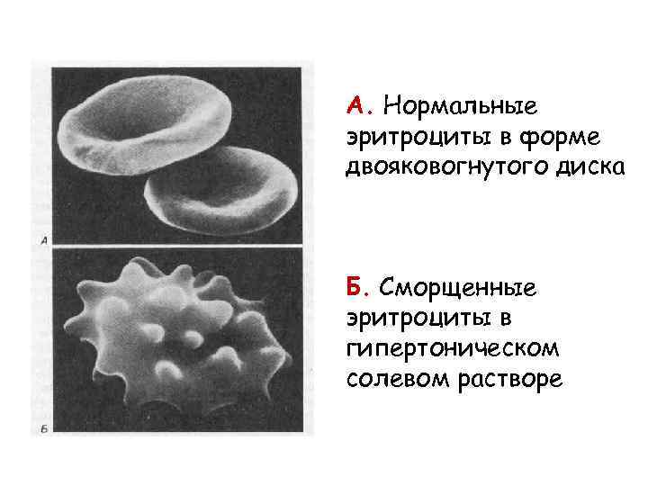 А. Нормальные эритроциты в форме двояковогнутого диска Б. Сморщенные эритроциты в гипертоническом солевом растворе