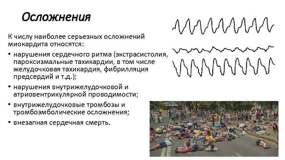 Осложнения К числу наиболее серьезных осложнений миокардита относятся: • нарушения сердечного ритма (экстрасистолия, пароксизмальные