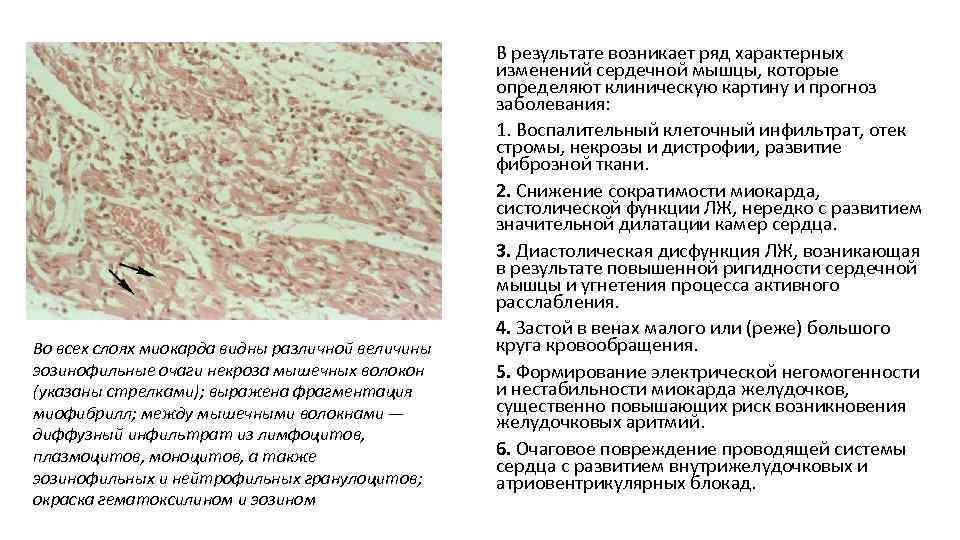 Во всех слоях миокарда видны различной величины эозинофильные очаги некроза мышечных волокон (указаны стрелками);