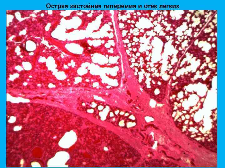 Острая застойная гиперемия и отек легких 