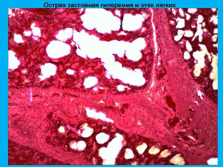 Острая застойная гиперемия и отек легких 