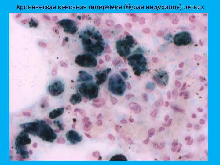 Хроническая венозная гиперемия (бурая индурация) легких 