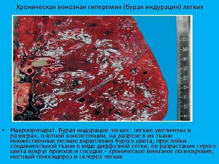 Хроническая венозная гиперемия (бурая индурация) легких • Макропрепарат. Бурая индурация легких: легкие увеличены в