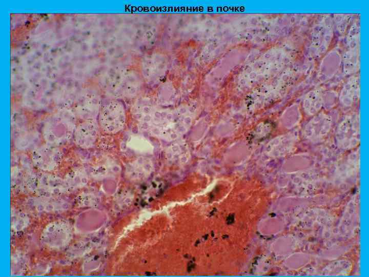 Кровоизлияние в почке 