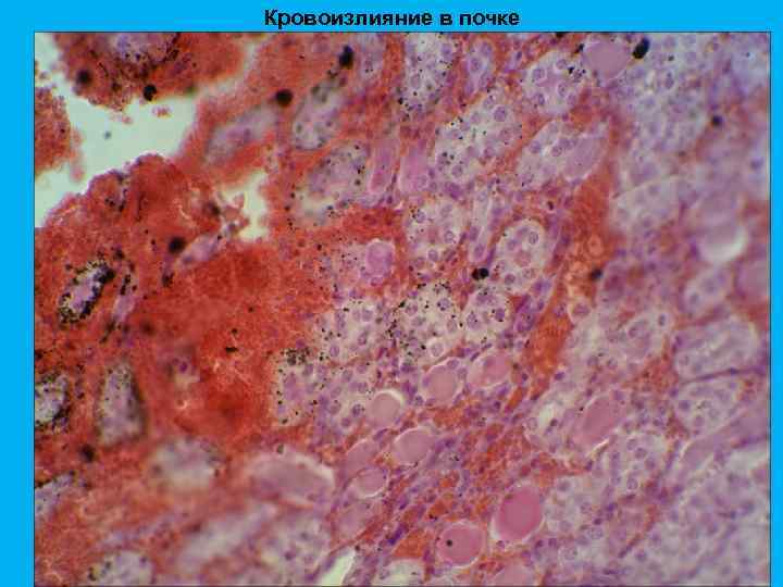 Кровоизлияние в почке 