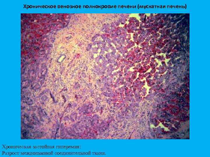 Хроническое венозное полнокровие печени (мускатная печень) Хроническая застойная гиперемия: Разрост междольковой соединительной ткани. 