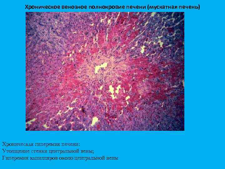Хроническое венозное полнокровие печени микропрепарат рисунок