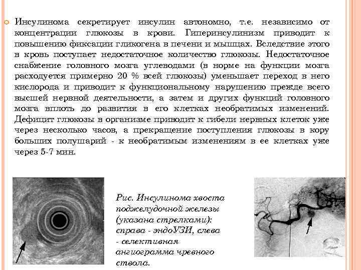  Инсулинома секретирует инсулин автономно, т. е. независимо от концентрации глюкозы в крови. Гиперинсулинизм