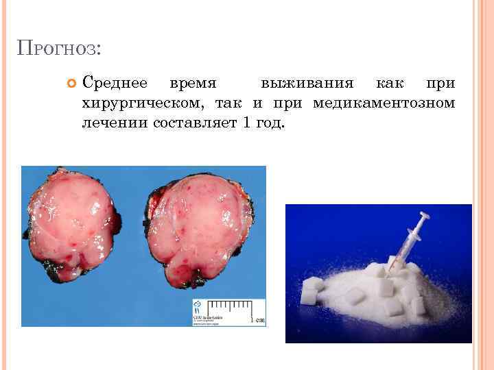 ПРОГНОЗ: Среднее время выживания как при хирургическом, так и при медикаментозном лечении составляет 1