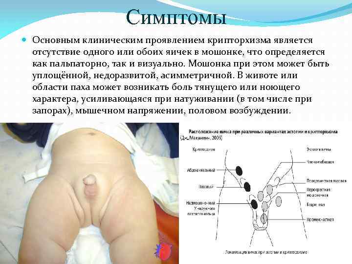 Симптомы Основным клиническим проявлением крипторхизма является отсутствие одного или обоих яичек в мошонке, что