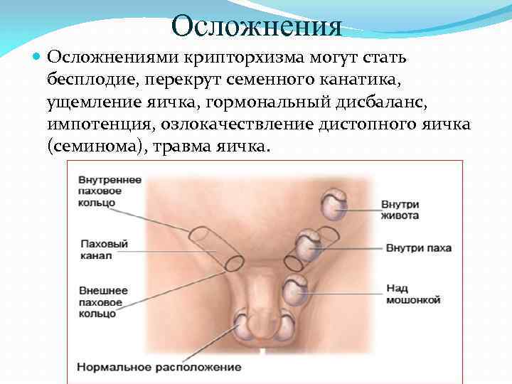 Осложнения Осложнениями крипторхизма могут стать бесплодие, перекрут семенного канатика, ущемление яичка, гормональный дисбаланс, импотенция,