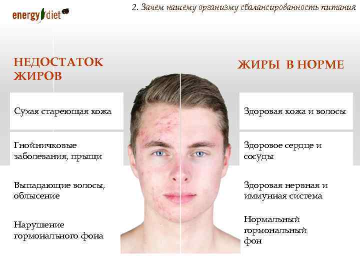 2. Зачем нашему организму сбалансированность питания НЕДОСТАТОК ЖИРОВ ЖИРЫ В НОРМЕ Сухая стареющая кожа