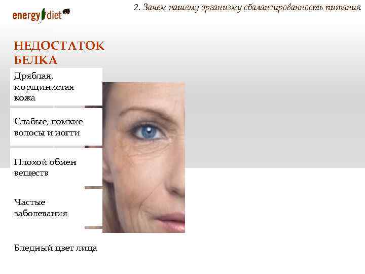 2. Зачем нашему организму сбалансированность питания НЕДОСТАТОК БЕЛКА Дряблая, морщинистая кожа Слабые, ломкие волосы