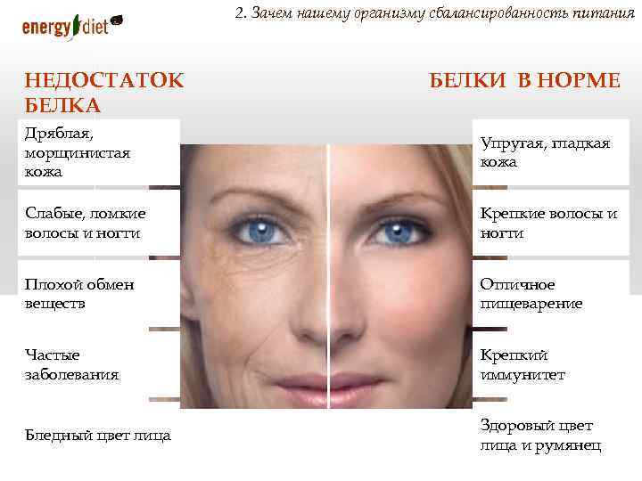 2. Зачем нашему организму сбалансированность питания НЕДОСТАТОК БЕЛКА БЕЛКИ В НОРМЕ Дряблая, морщинистая кожа