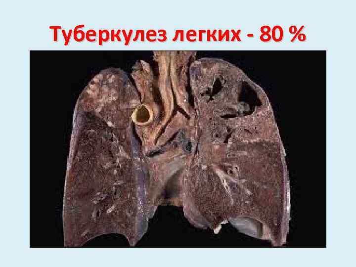 Туберкулез легких - 80 % 
