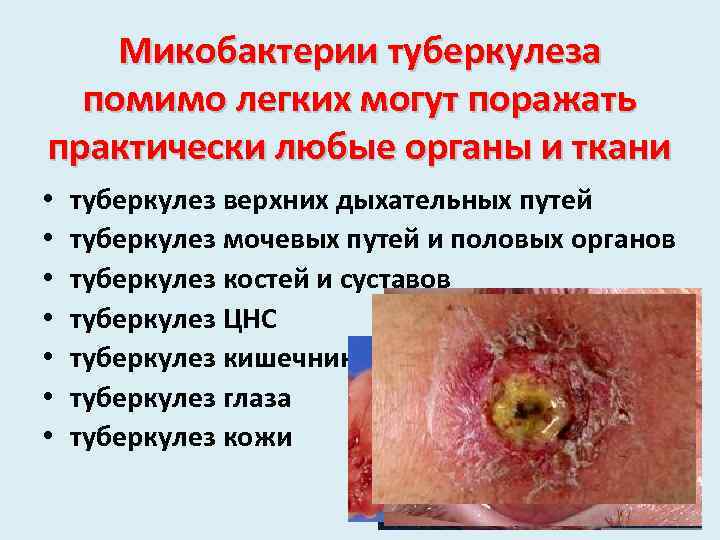 Микобактерии туберкулеза помимо легких могут поражать практически любые органы и ткани • • туберкулез