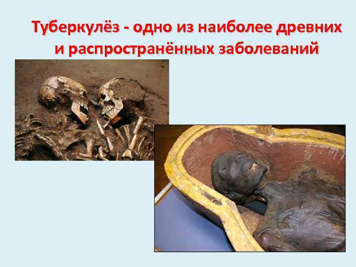 Туберкулёз - одно из наиболее древних и распространённых заболеваний 