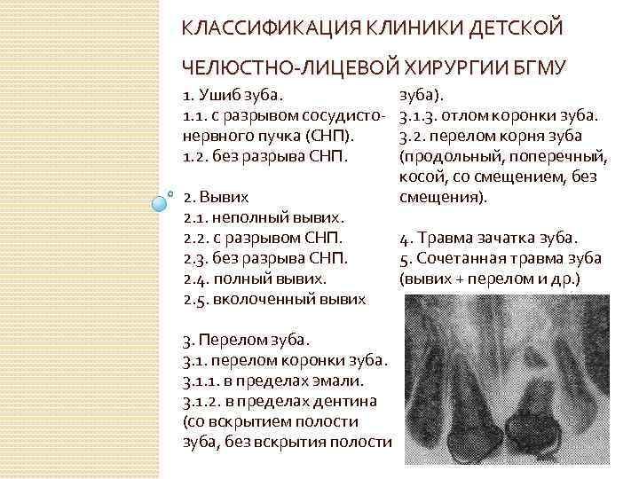 КЛАССИФИКАЦИЯ КЛИНИКИ ДЕТСКОЙ ЧЕЛЮСТНО-ЛИЦЕВОЙ ХИРУРГИИ БГМУ 1. Ушиб зуба. 1. 1. с разрывом сосудистонервного